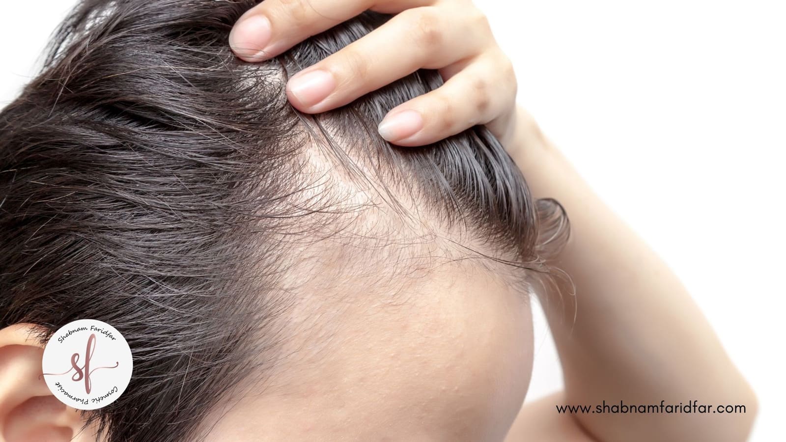 اتیولوژی ریزش مو یا آلوپسی
