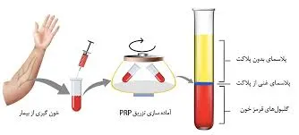 پلاسمای غنی از پلاکت