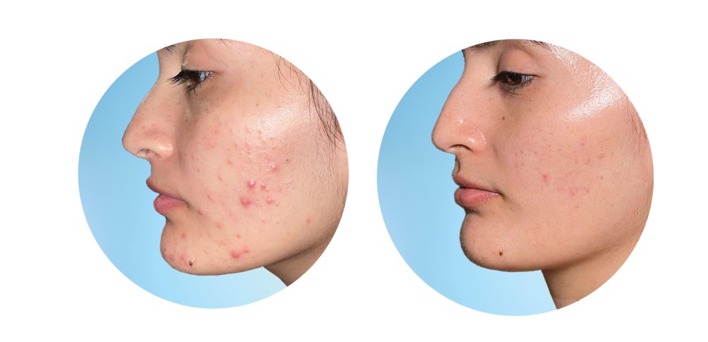 ژل ضد جوش دیفرین